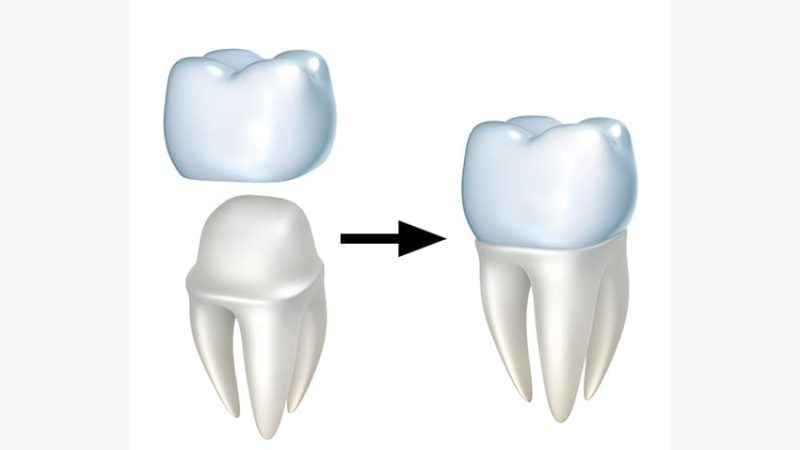 Importance of Dental Crowns