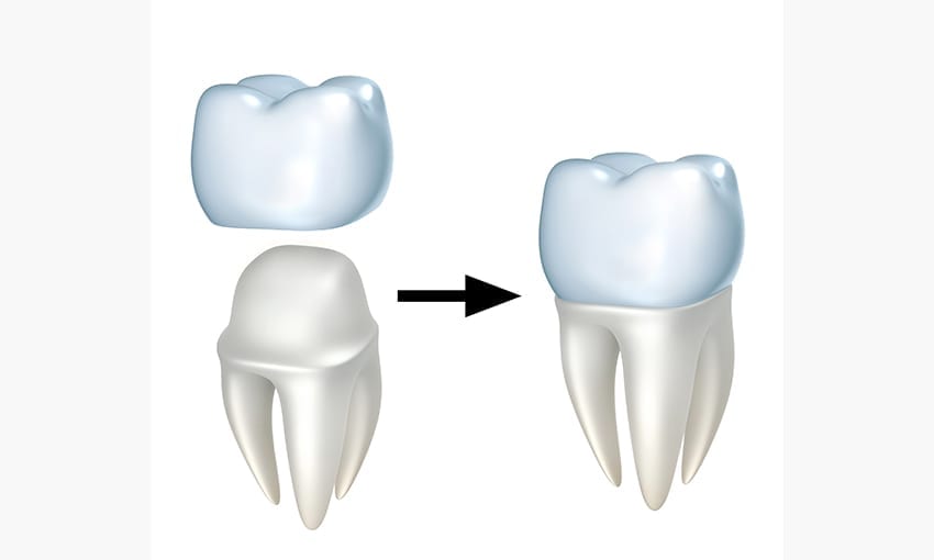 Importance of Dental Crowns